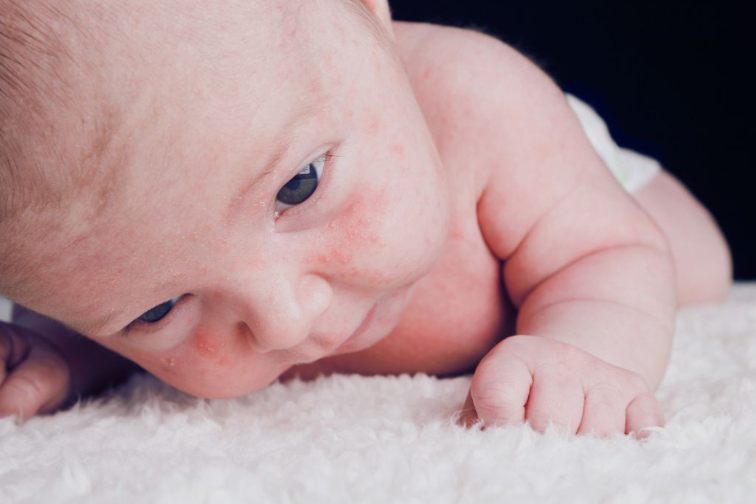 atiopijski dermatitis kod beba